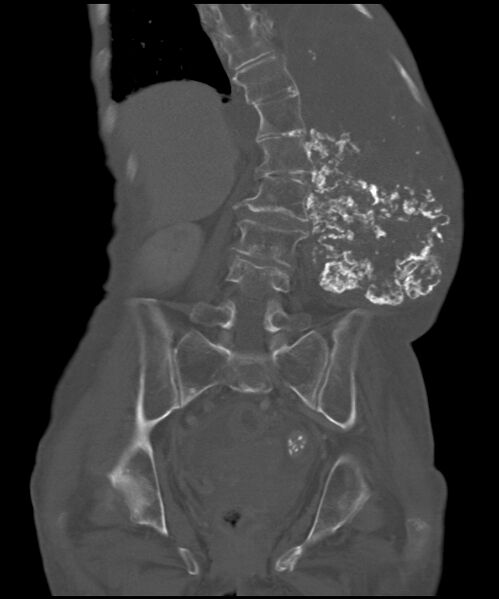 File:Chondrosarcoma of the spine (Radiopaedia 49871-55143 Coronal bone window 11).jpg