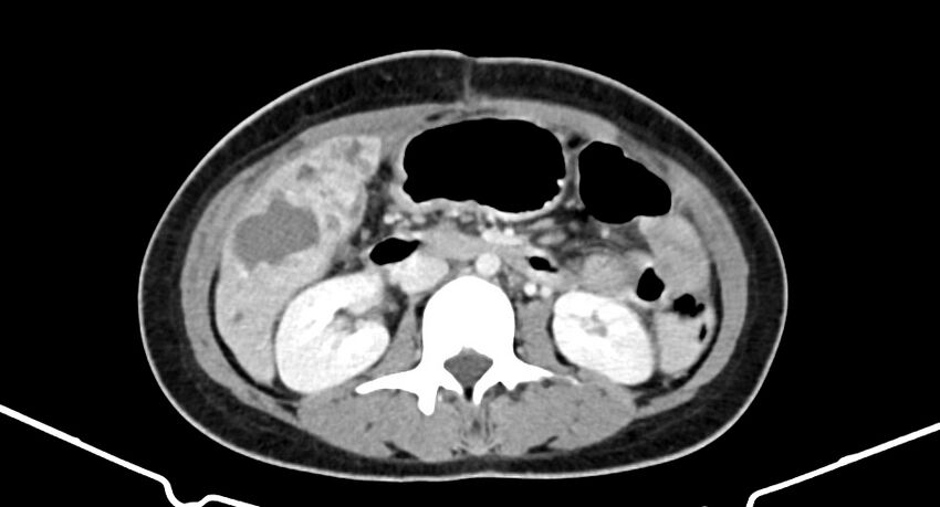 Choriocarcinoma liver metastases (Radiopaedia 74768-85766 A 102).jpg