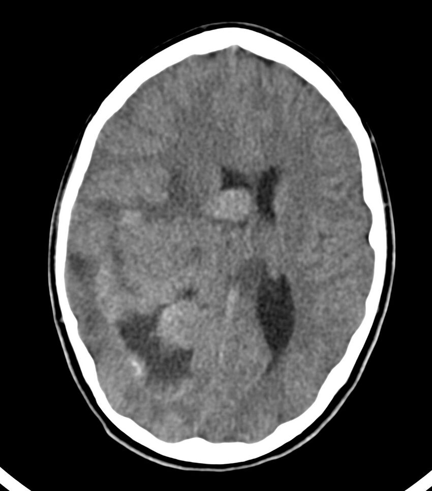 Choroid plexus carcinoma (Radiopaedia 91013-108552 Axial non-contrast 35).jpg