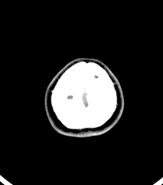 File:Choroid plexus carcinoma (Radiopaedia 91013-108552 Axial non-contrast 58).jpg