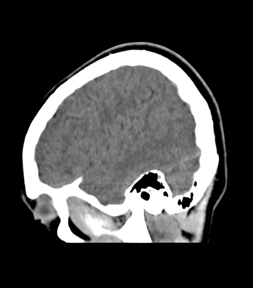 Choroid plexus carcinoma (Radiopaedia 91013-108552 B 16).jpg