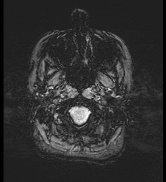 File:Choroid plexus xanthogranuloma (Radiopaedia 91271-108875 Axial SWI 6).jpg