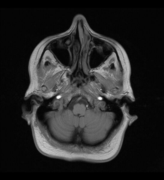 File:Choroid plexus xanthogranuloma (Radiopaedia 91271-108875 Axial T1 5).jpg
