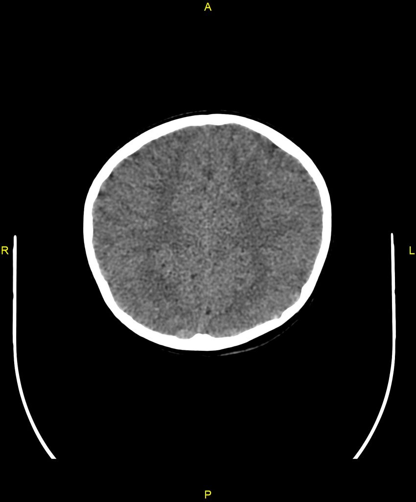 Choroidal fissure cyst (Radiopaedia 89481-106465 Axial non-contrast 88).jpg
