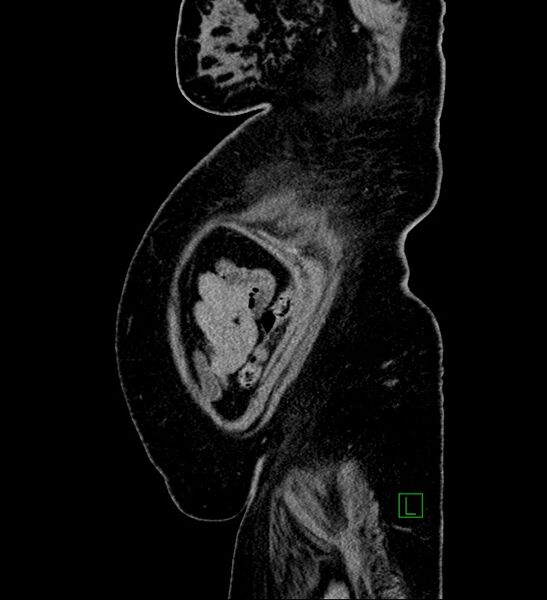 File:Chromophobe renal cell carcinoma (Radiopaedia 84239-99519 G 11).jpg