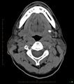 Chronic Submandibular sialolithiasis (Radiopaedia 16880-16606 Axial non-contrast 15).jpg