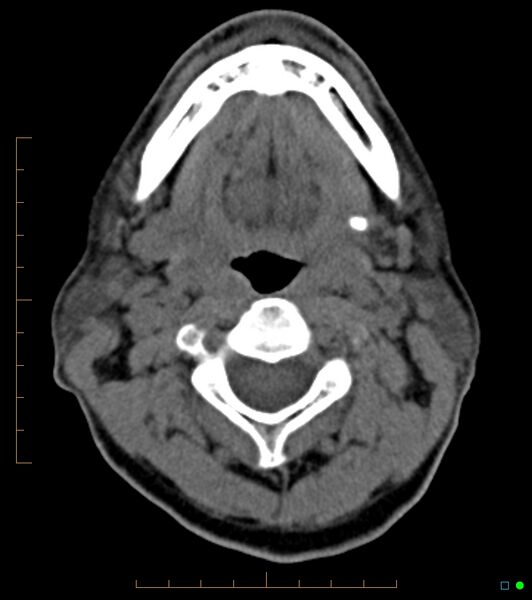 File:Chronic Submandibular sialolithiasis (Radiopaedia 16880-16606 Axial non-contrast 15).jpg
