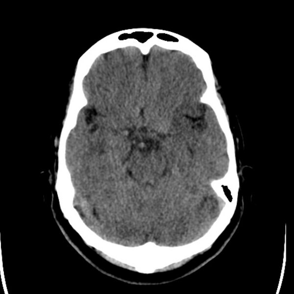 File:Chronic bilateral occipital lobe infarcts (Radiopaedia 31276-31996 Axial non-contrast 15).jpg