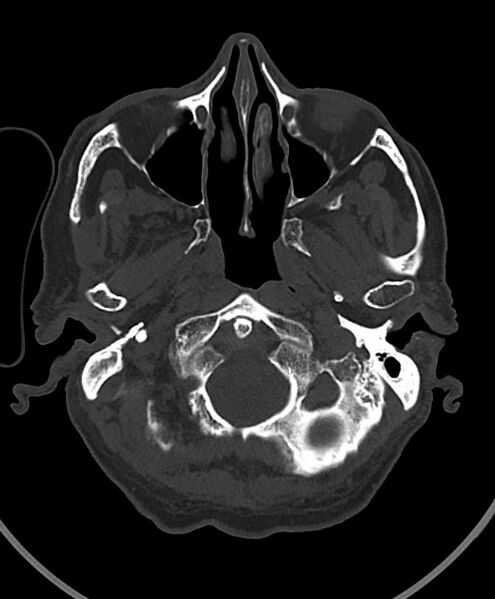 File:Chronic bilateral subdural hygroma (Radiopaedia 85801-101623 Axial bone window 105).jpg