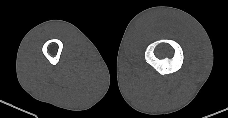 File:Chronic osteomyelitis (with sequestrum) (Radiopaedia 74813-85822 Axial non-contrast 115).jpg