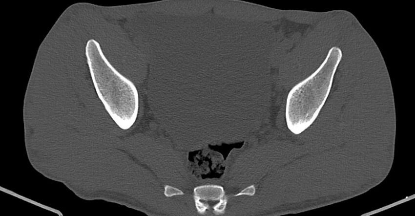 Chronic osteomyelitis (with sequestrum) (Radiopaedia 74813-85822 Axial non-contrast 23).jpg