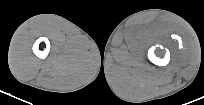 Chronic osteomyelitis (with sequestrum) (Radiopaedia 74813-85822 D 89).jpg