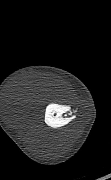 File:Chronic osteomyelitis of the distal humerus (Radiopaedia 78351-90971 Axial bone window 55).jpg