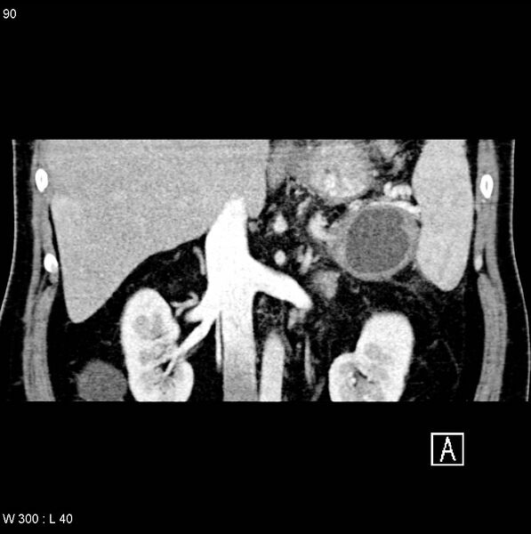 File:Chronic pancreatitis and pseudocysts (Radiopaedia 6724-7935 C 10).jpg