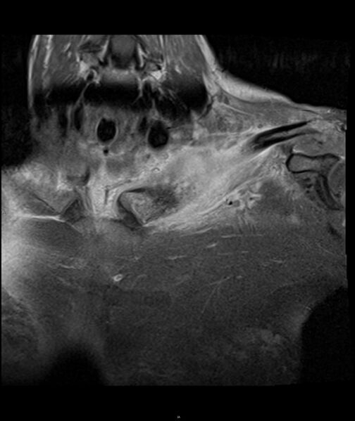 File:Chronic reactive multifocal osteomyelitis (CRMO) - clavicle (Radiopaedia 56406-63071 D 4).jpg