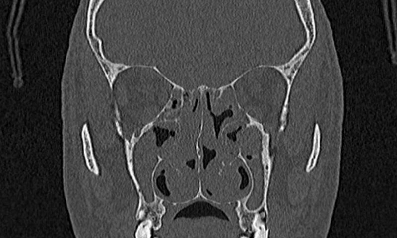 File:Chronic rhinosinusitis (Radiopaedia 65079-74075 Coronal bone window 43).jpg