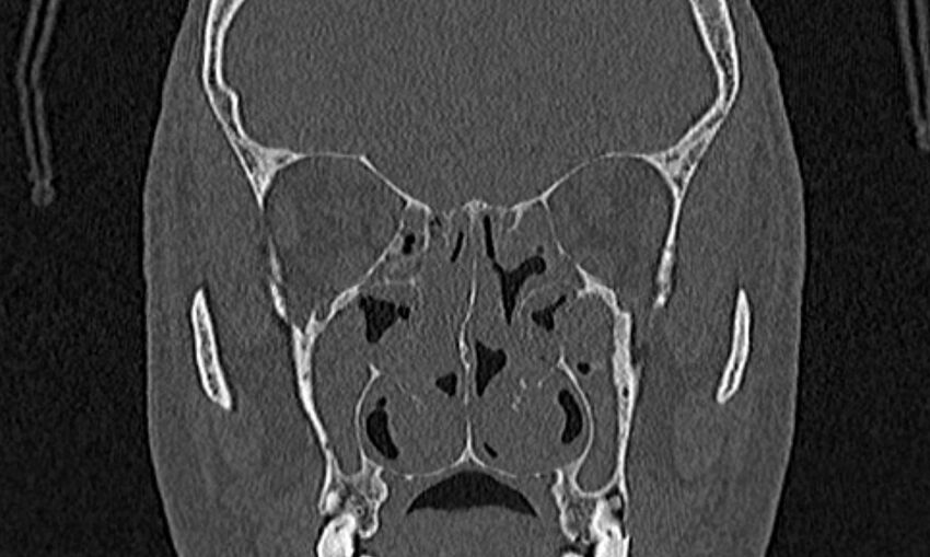 Chronic rhinosinusitis (Radiopaedia 65079-74075 Coronal bone window 43).jpg