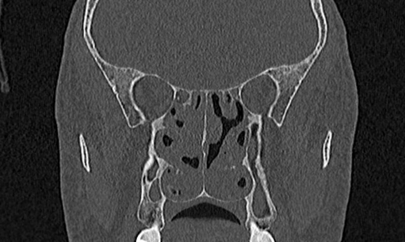 File:Chronic rhinosinusitis (Radiopaedia 65079-74075 Coronal bone window 51).jpg