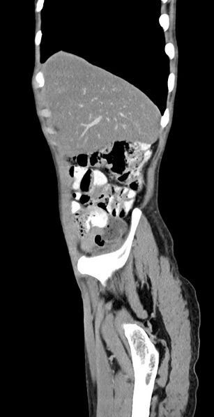 File:Chronic small bowel volvulus (Radiopaedia 75224-86322 C 123).jpg