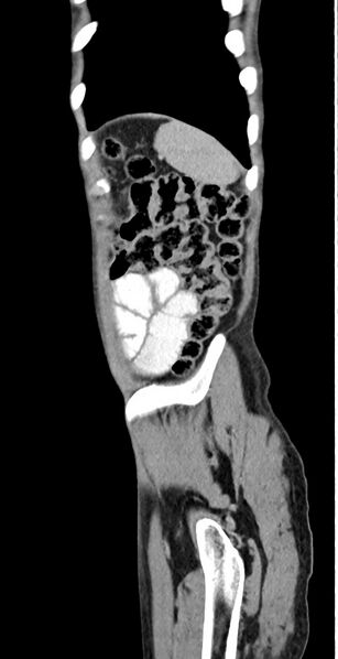 File:Chronic small bowel volvulus (Radiopaedia 75224-86322 C 24).jpg