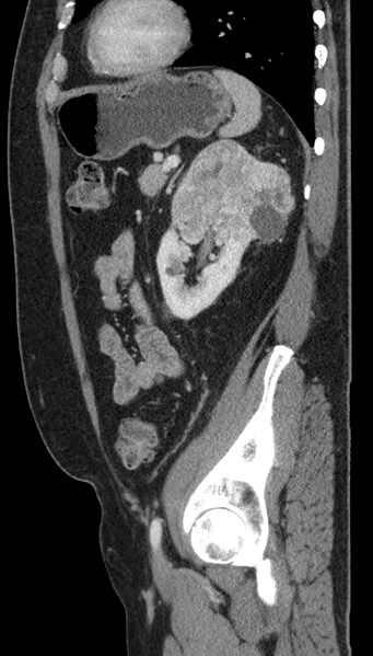 File:Clear cell renal cell carcinoma (Radiopaedia 61449-69393 G 25).jpg