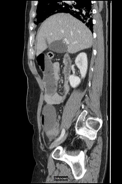 File:Closed loop bowel obstruction and ischemia (Radiopaedia 86959-103180 C 45).jpg