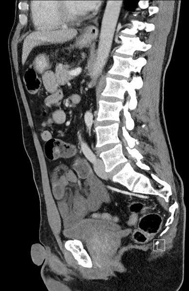 File:Closed loop small bowel obstruction - internal hernia (Radiopaedia 57806-64778 C 52).jpg