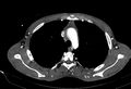 Coarctation of aorta with aortic valve stenosis (Radiopaedia 70463-80574 A 36).jpg