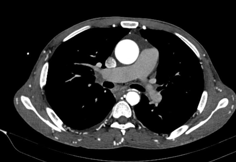 File:Coarctation of aorta with aortic valve stenosis (Radiopaedia 70463-80574 A 78).jpg