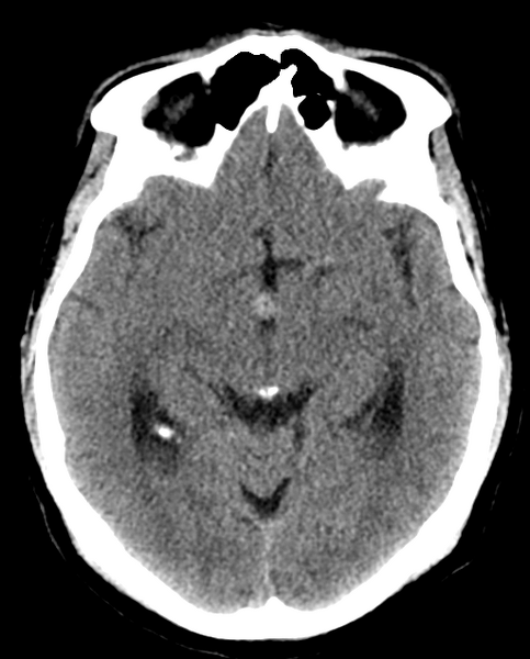 File:Colloid cyst of the third ventricle (Radiopaedia 86571-102661 Axial non-contrast 15).png