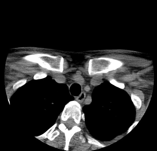 File:Colloid cyst of thyroid (Radiopaedia 22897-22923 Axial non-contrast 54).jpg
