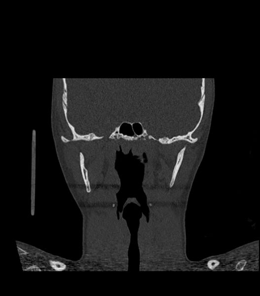 File:Nasoorbitoethmoid fracture (Radiopaedia 90044-107205 Coronal bone window 84).jpg
