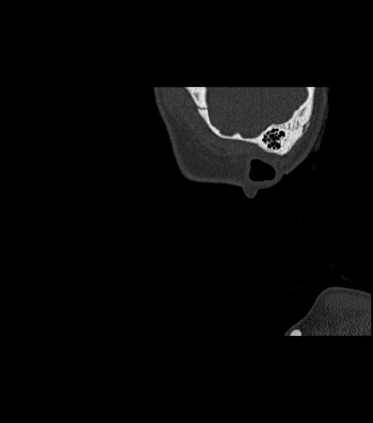 File:Nasoorbitoethmoid fracture (Radiopaedia 90044-107205 Sagittal bone window 11).jpg