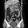 Necrotizing pancreatitis (Radiopaedia 23001-23031 B 29).jpg