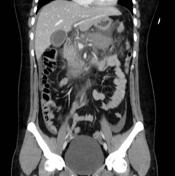 File:Necrotizing pancreatitis (Radiopaedia 23001-23031 B 29).jpg
