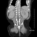 Neonatal neuroblastoma (Radiopaedia 56651-63438 Coronal non-contrast 40).jpg