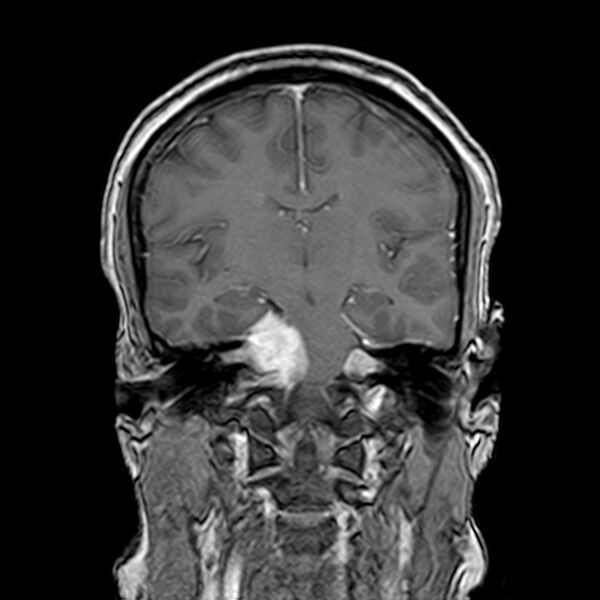 File:Neurofibromatosis type 2 (Radiopaedia 67470-76871 Coronal T1 C+ 14).jpg