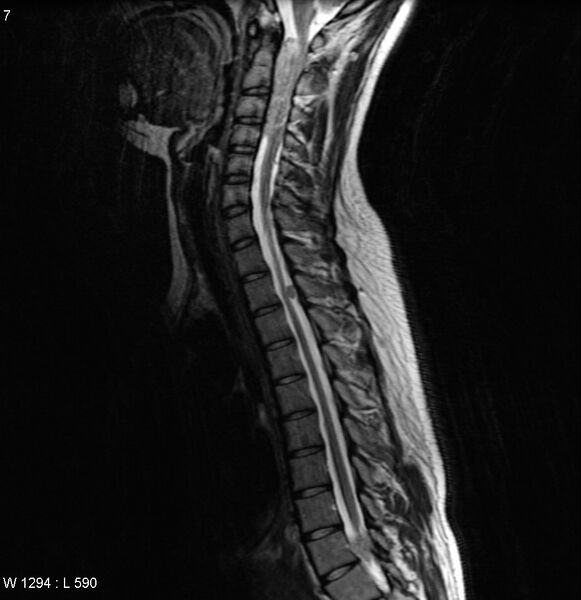 File:Neurofibromatosis type 2 - cranial and spinal involvement (Radiopaedia 5351-7112 Sagittal T2 4).jpg