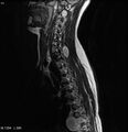 Neurofibromatosis type 2 - cranial and spinal involvement (Radiopaedia 5351-7112 Sagittal T2 8).jpg