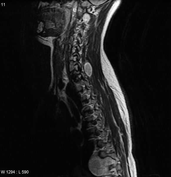 File:Neurofibromatosis type 2 - cranial and spinal involvement (Radiopaedia 5351-7112 Sagittal T2 8).jpg
