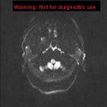 Neuroglial cyst (Radiopaedia 10713-11184 Axial DWI 44).jpg