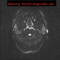 Neuroglial cyst (Radiopaedia 10713-11184 Axial DWI 45).jpg