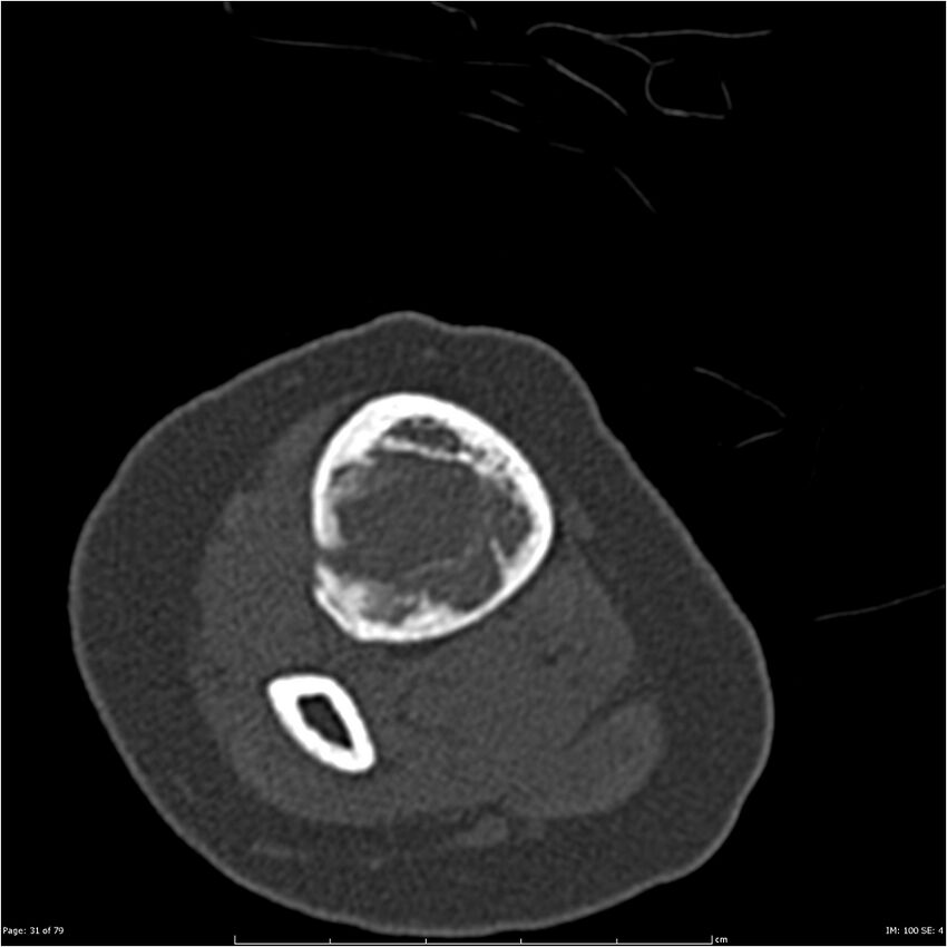 Non-ossifying fibroma (Radiopaedia 23651-23780 bone window 31).jpg