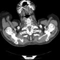 Non Hodgkin lymphoma in a patient with ankylosing spondylitis (Radiopaedia 84323-99624 Axial non-contrast 3).jpg