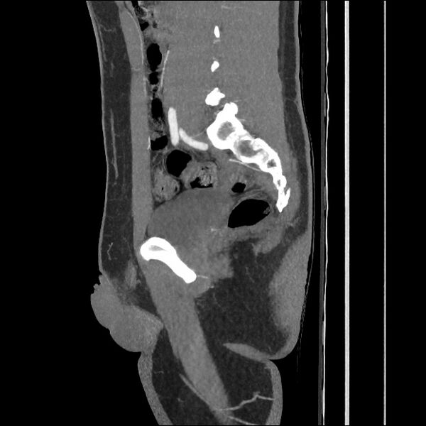 File:Normal CT angiogram of pelvis (Radiopaedia 45390-49430 C 42).jpg
