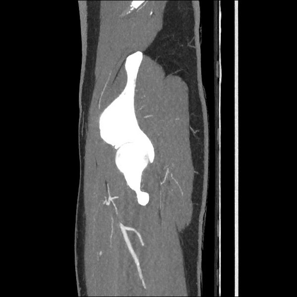 File:Normal CT angiogram of pelvis (Radiopaedia 45390-49430 C 57).jpg