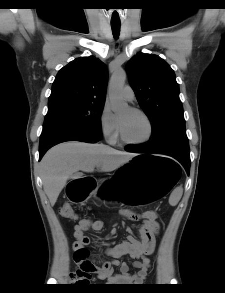 File:Normal CT virtual gastroscopy (Radiopaedia 29960-30501 E 13).jpg