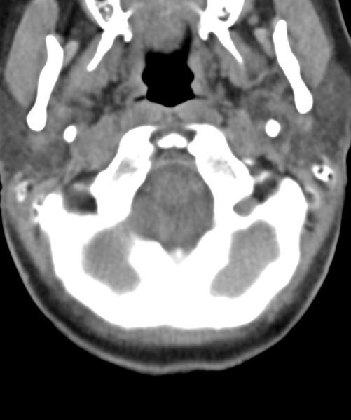File:Normal cervical spine MRI (including Dixon) (Radiopaedia 42762-45926 Axial non-contrast 8).png