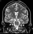Normal coronal brain (Radiopaedia 6676-7910 Coronal T2 20).jpg