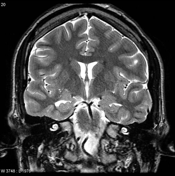 File:Normal coronal brain (Radiopaedia 6676-7910 Coronal T2 20).jpg